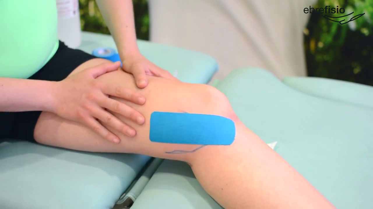 Vendaje neuromuscular para la tendinitis de pata de ganso